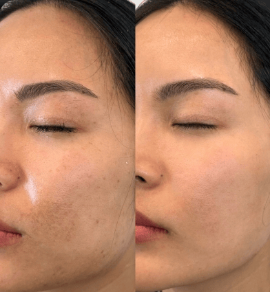 Rodillo facial absorbente de grasa ®